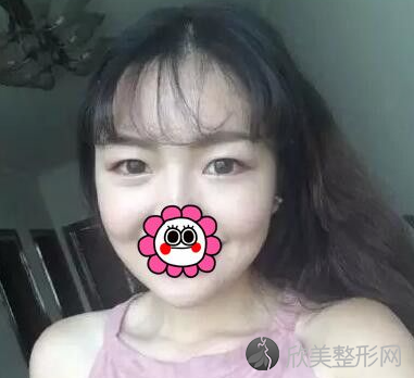 成都八大处医疗美容医院于晓波医眼部手术案例——双眼皮（术前）