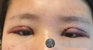 在上海伊莱美孙美庆医生这里做了双眼皮手术,眼睛又大又美