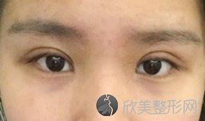 在上海伊莱美孙美庆医生这里做了双眼皮手术,眼睛又大又美