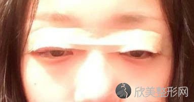 在上海九院李圣利这里做全切双眼皮手术,整个人颜值提升了不少