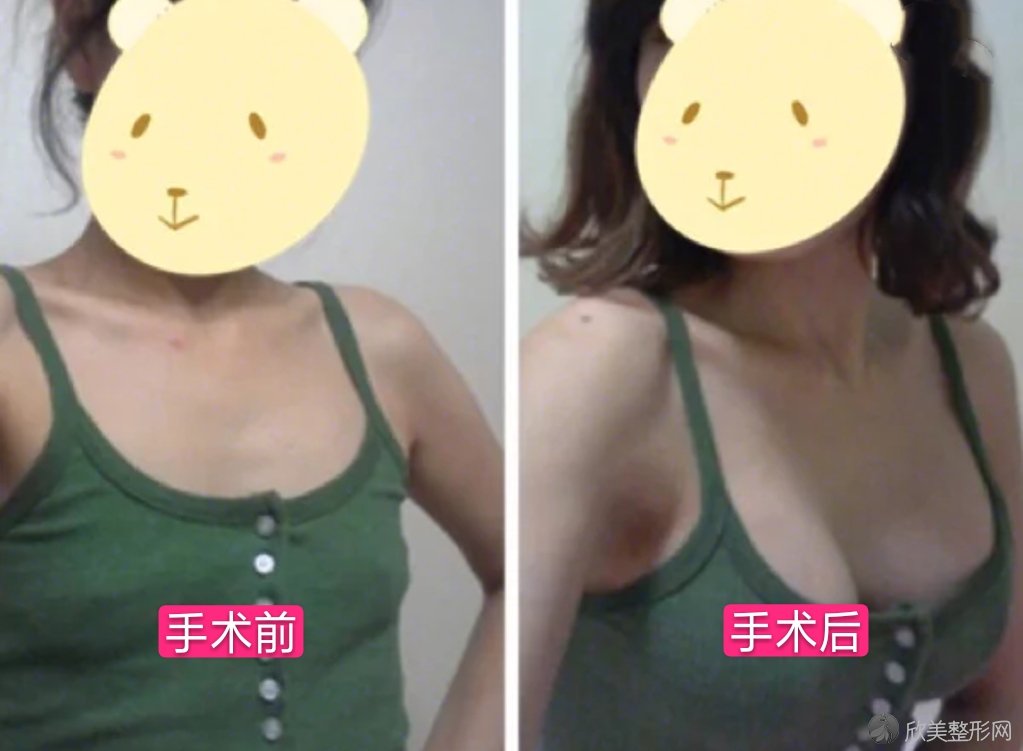 上海韩镜医疗美容医院李科做脂肪移植怎么样？让你的身材更加棒