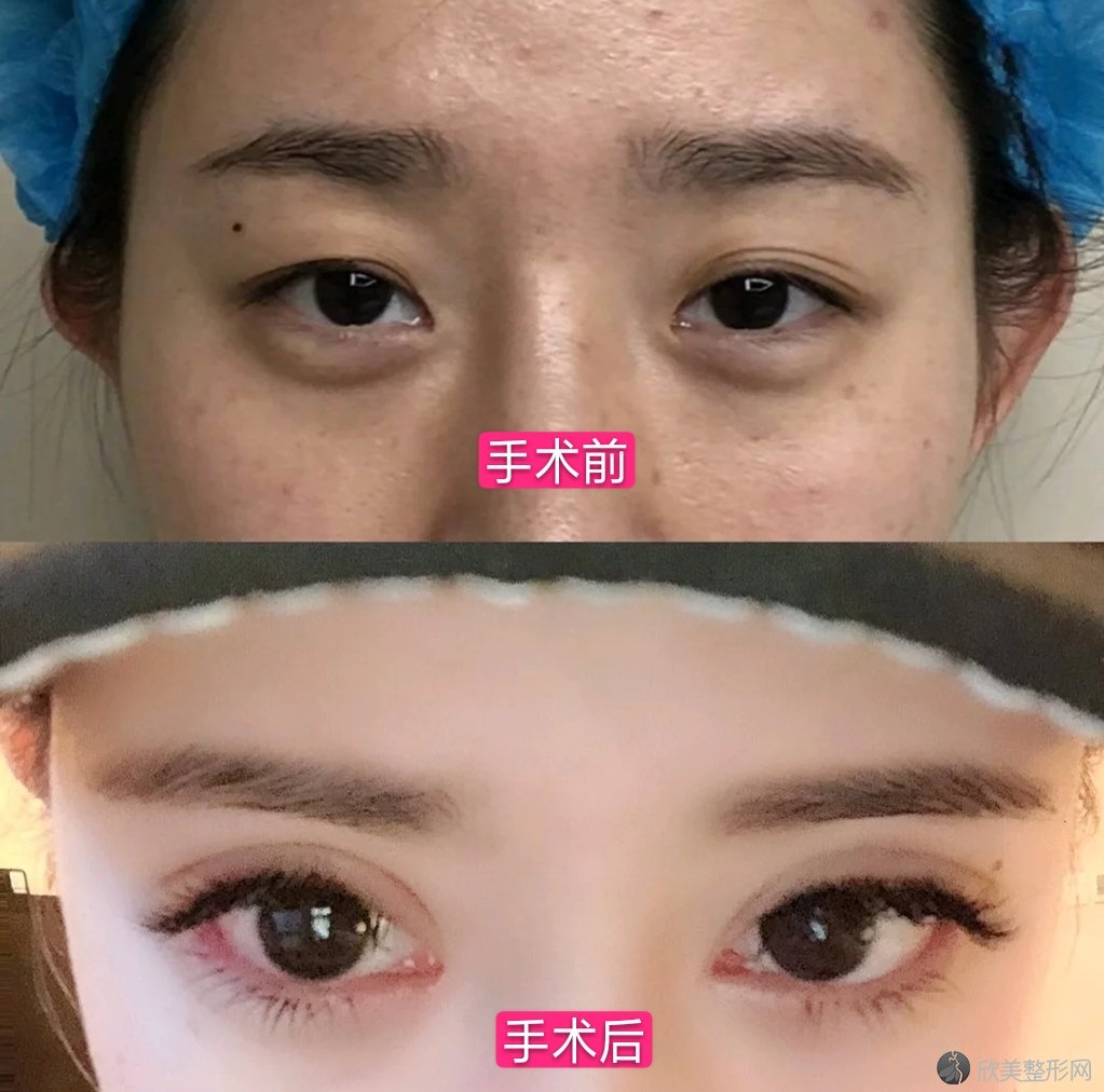 上海韩镜医疗美容医院高中玉做眼部整形怎么样？效果案例图,价格