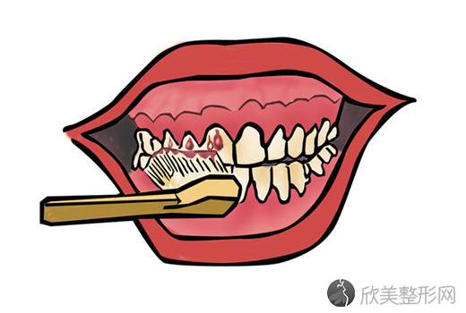 牙龈炎和牙周炎的区别 