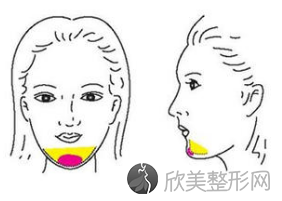 长沙吸脂-脂肪填充医院医生攻略