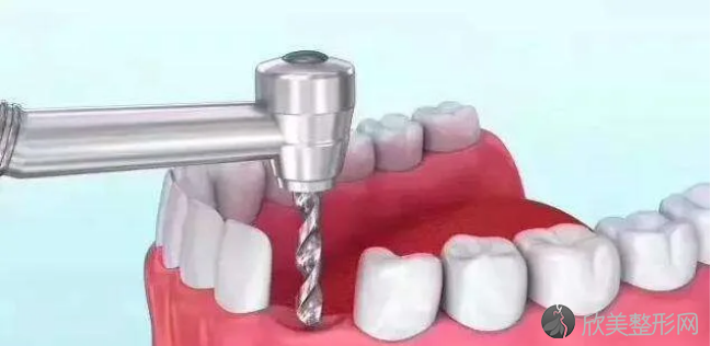 口腔医院牙种植