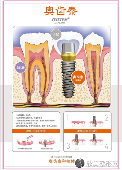 韩国奥齿泰种植牙的材料和使用寿命