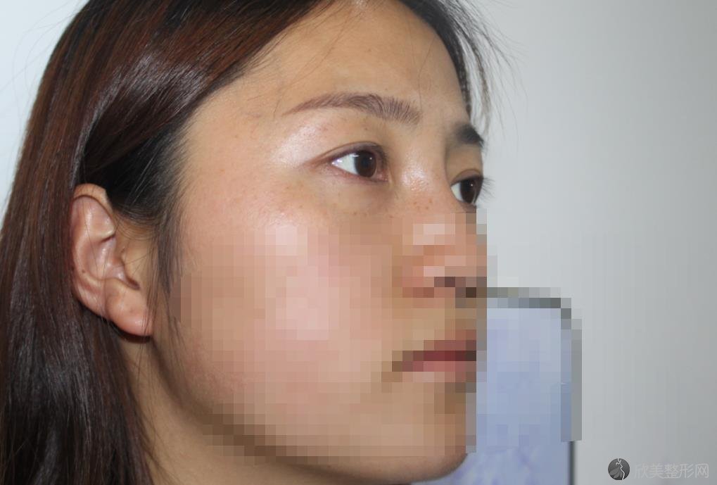 上海美莱整形双眼皮修复手术