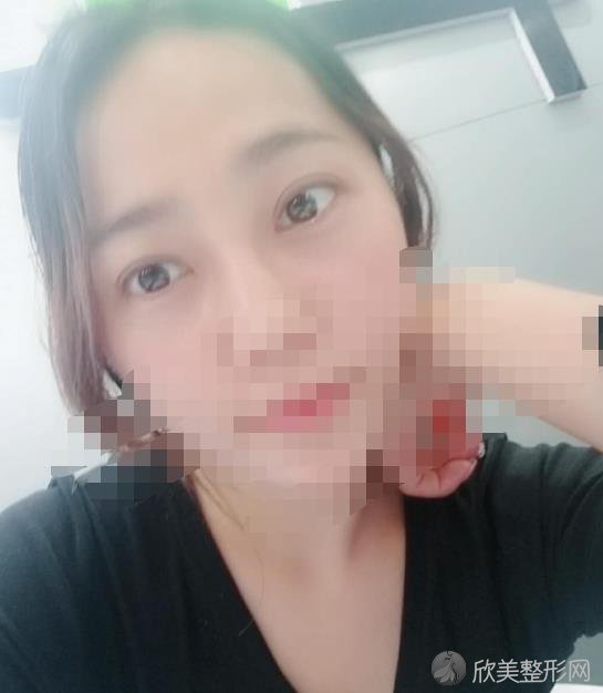上海美莱整形双眼皮修复手术