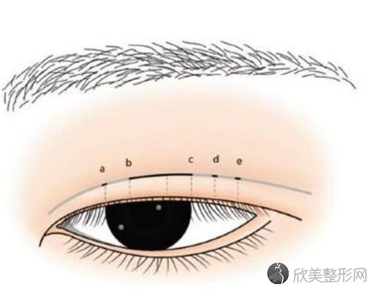 眼部整形