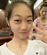 广州曙光医院杨晓英医生做双眼皮手术前后照来袭