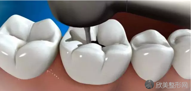 镶牙过程图解