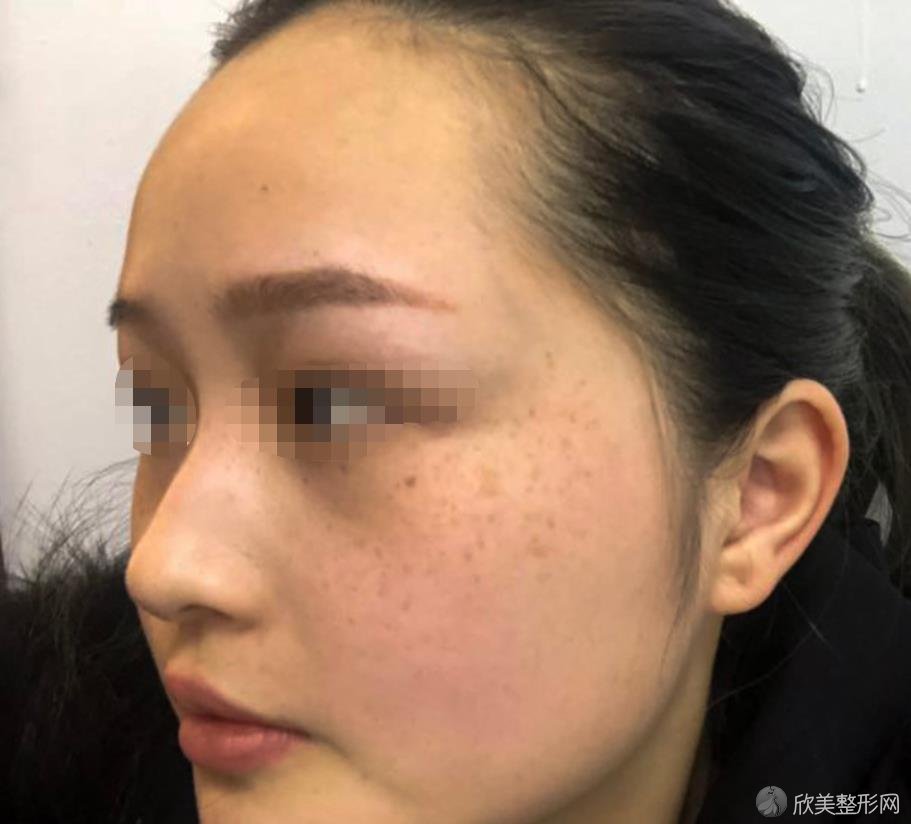 上海华美医疗美容田波医生祛斑的技术如何？