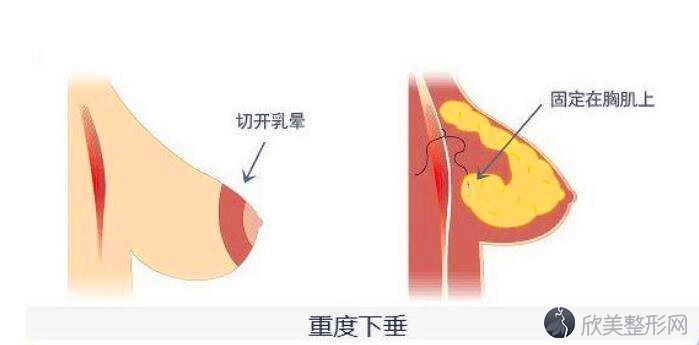 胸部悬吊术