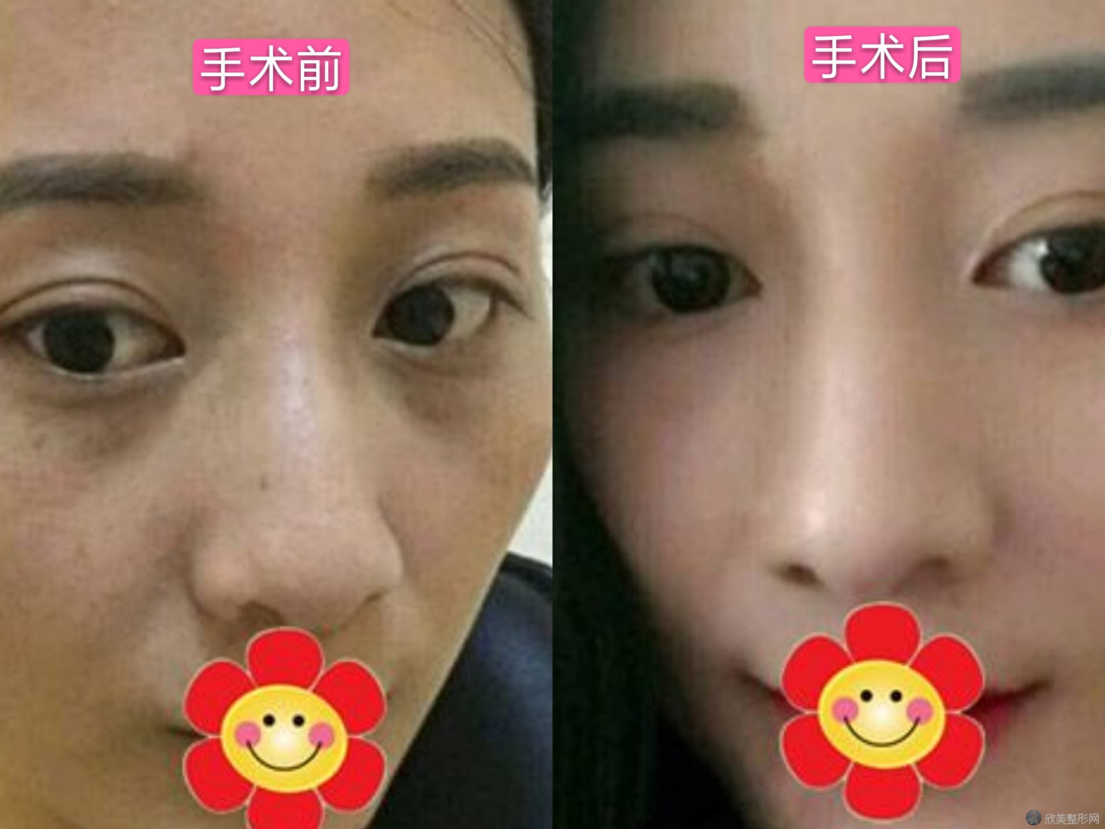 长沙爱思特激光祛斑真人案例分享