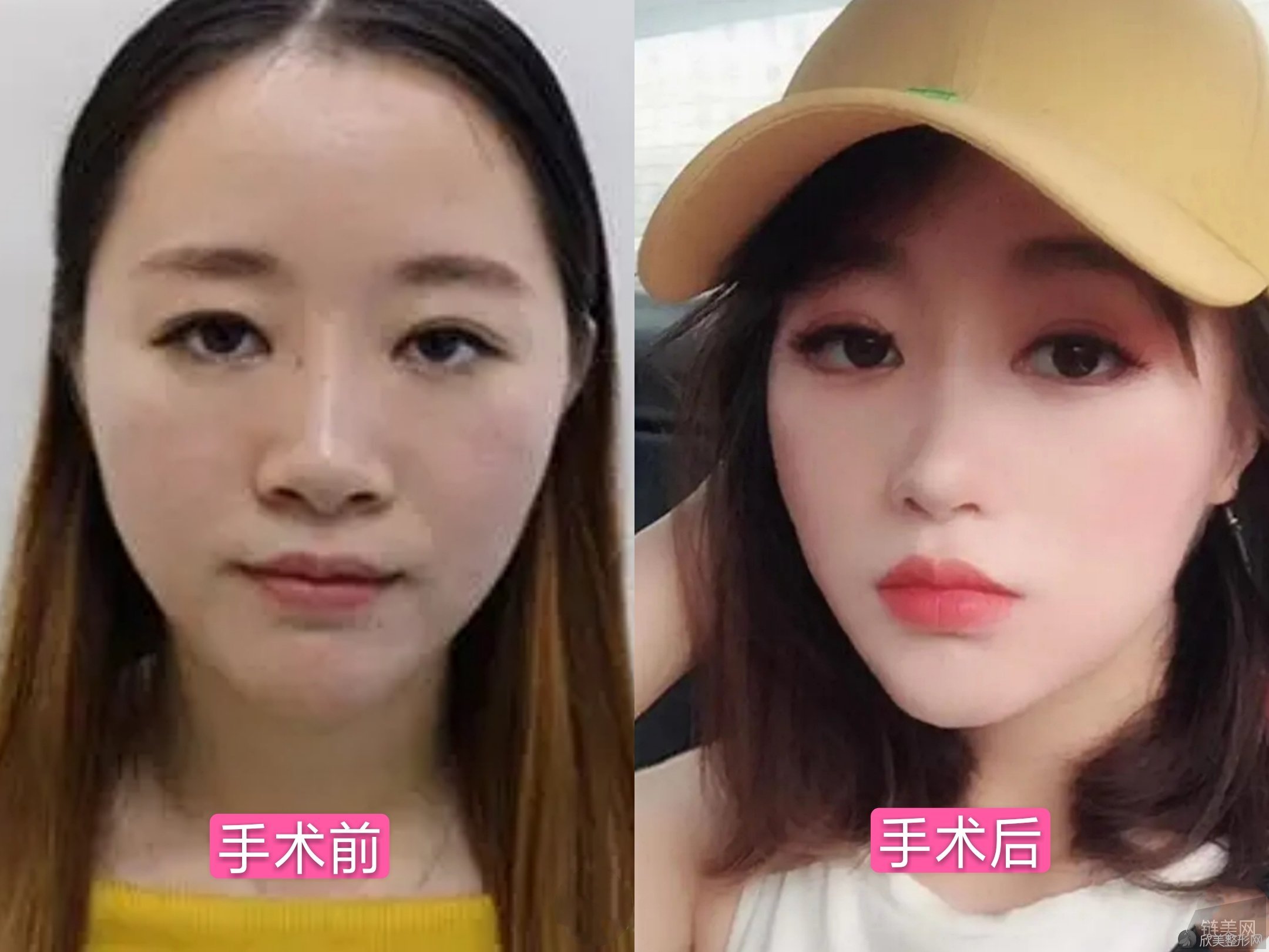 西京整形医院隆鼻案例术前术后对比图