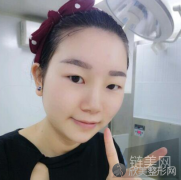 华西李正勇做双眼皮整形手术案例，一个月恢复效果分享