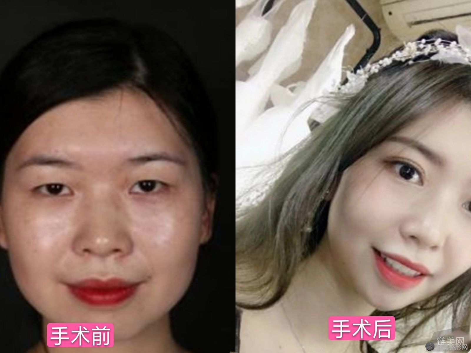 米兰柏羽,双眼皮,价格,专家