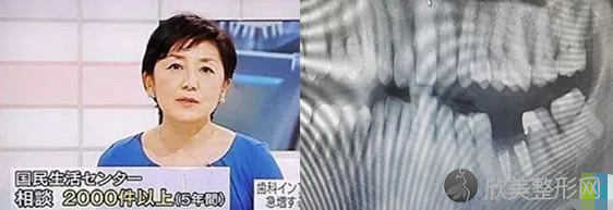日本为什么停止种植牙