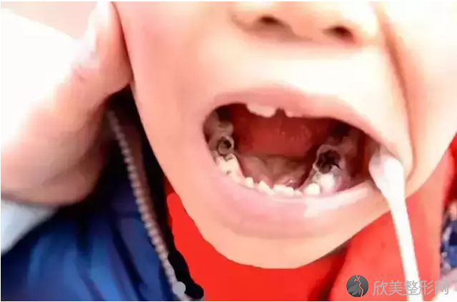 12岁前必须处理的牙齿问题