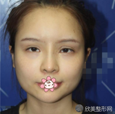 北京八大处美容医院下颌角磨骨手术前