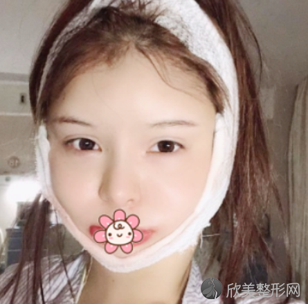 北京八大处美容医院下颌角磨骨术后第3天
