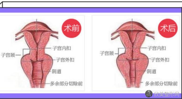 私密整形