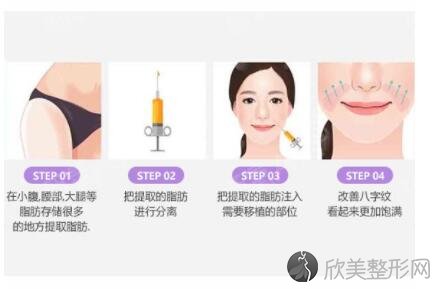 自体脂肪填充鼻唇沟效果怎么样 术后怎么护理 欣美整形网 自体脂肪填充鼻唇沟效果怎么样 术后怎么护理 欣美整形网