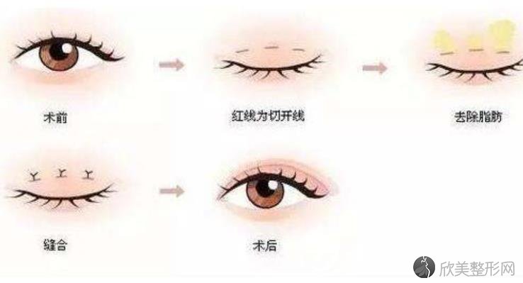 六点定位双眼皮