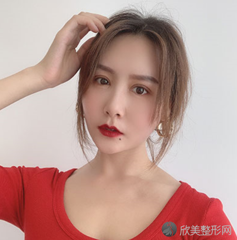 眼综合整形术后27天