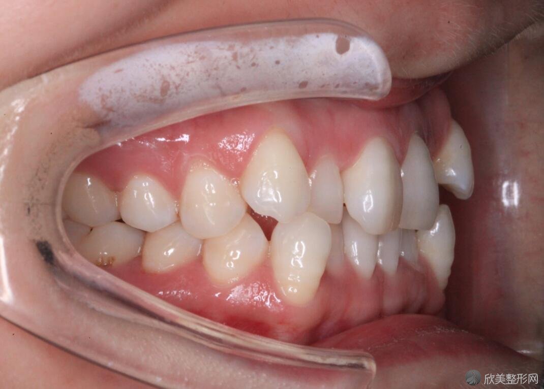 牙齿矫正术前