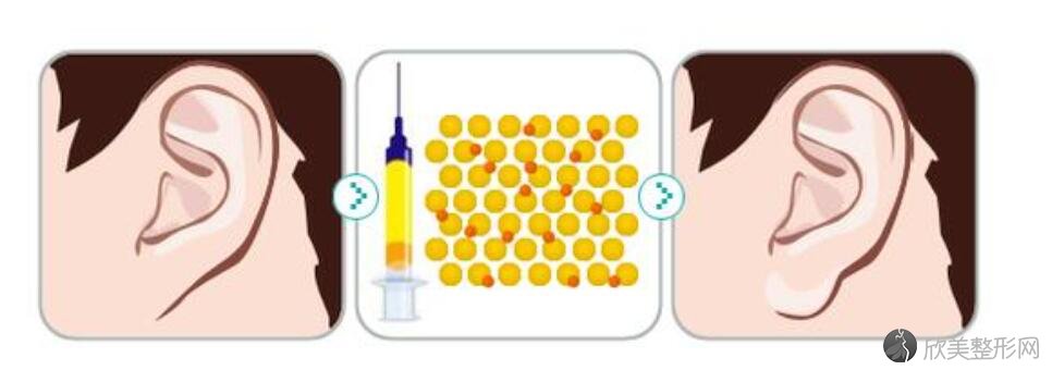 玻尿酸注射丰耳垂