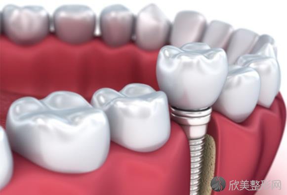 种植牙的材料主要有哪些？纯钛是什么材质?