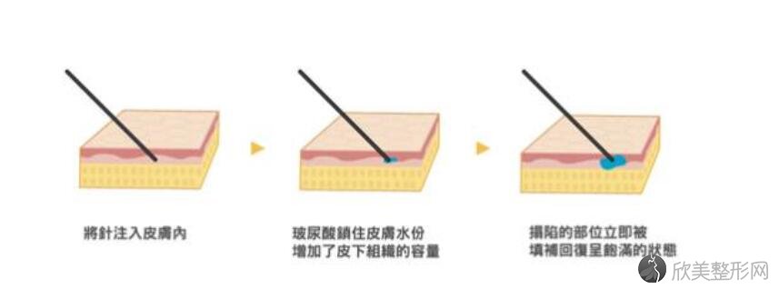 玻尿酸丰面颊