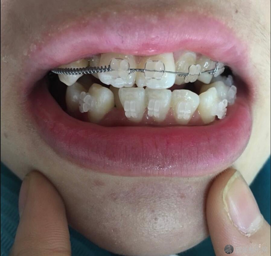 牙齿矫正术后10天