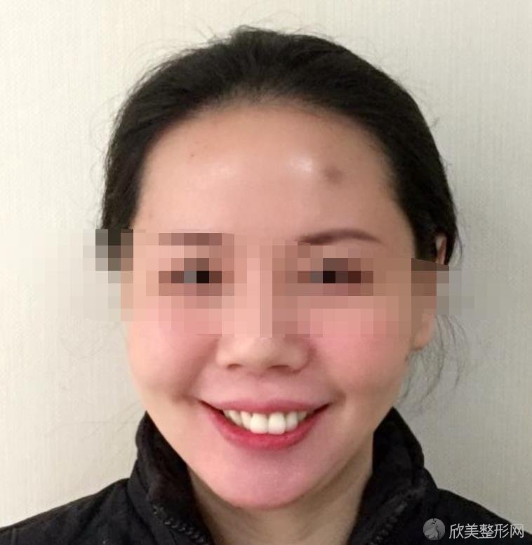 骨性龅牙矫正前后图片 堪比整容 丑女变成美女的演变过程 欣美整形网 骨性龅牙矫正前后图片 堪比整容 丑女变成美女的演变过程 欣美整形网