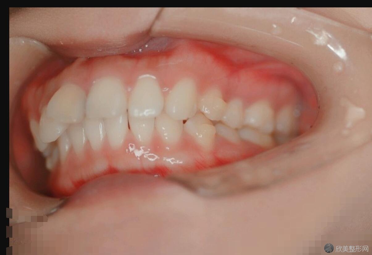 牙齿矫正术后30天