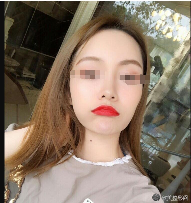 拔上下智齿脸型变化图 丑女到美女的升级 真实案例献上给大家瞧一瞧 欣美整形