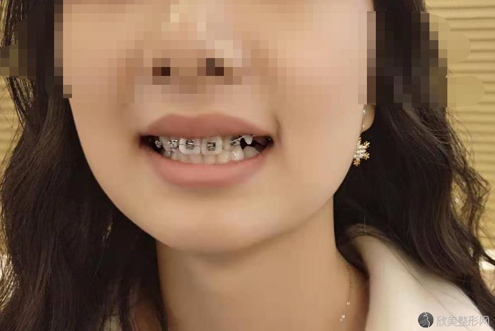 广州广大口腔评价怎么样？附上专家介绍及牙齿矫正案例分享！