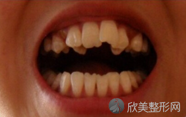 上海康态口腔地包天牙齿选矫正