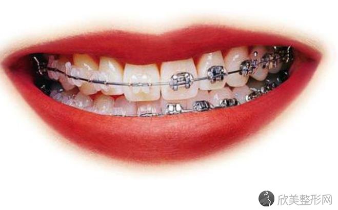 口腔科牙齿矫正价格是多少 附上2021年最新价格表哦 欣美整形