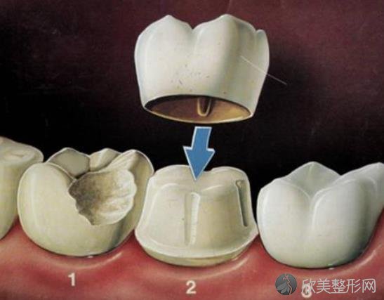 全陶瓷牙套