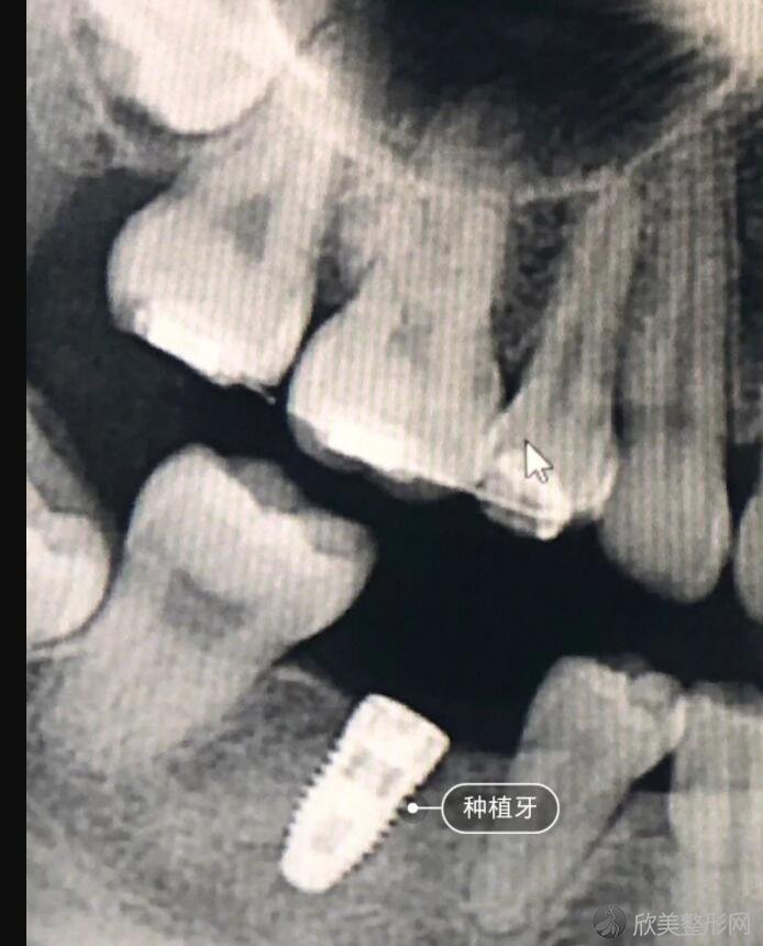 牙齿种植术前