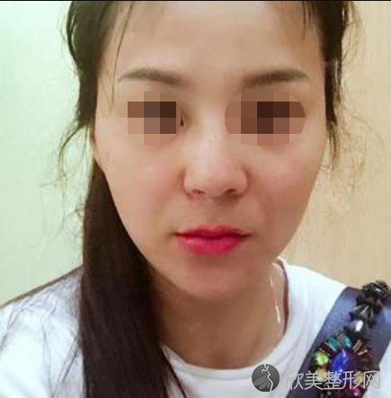 北京惠合嘉美医疗美容诊所刘蕊做法令纹去除