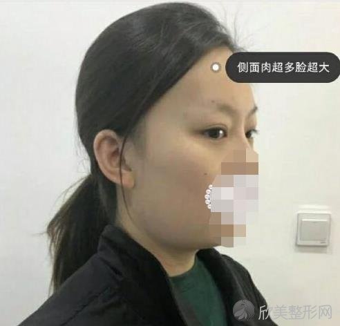 北京苏亚医疗美容医院的隋冰做面部吸脂之前