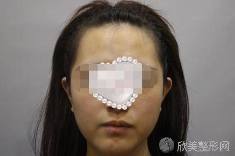 北京大学人民医院整形外科杨锴医生做埋线提升之前