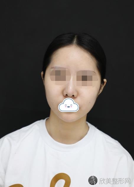 北京第一医科院附属昆明拉雅医疗美容做面部脂肪填充之前