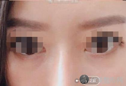 北京美莱医疗美容医院的王旭东医生做去眼袋手术