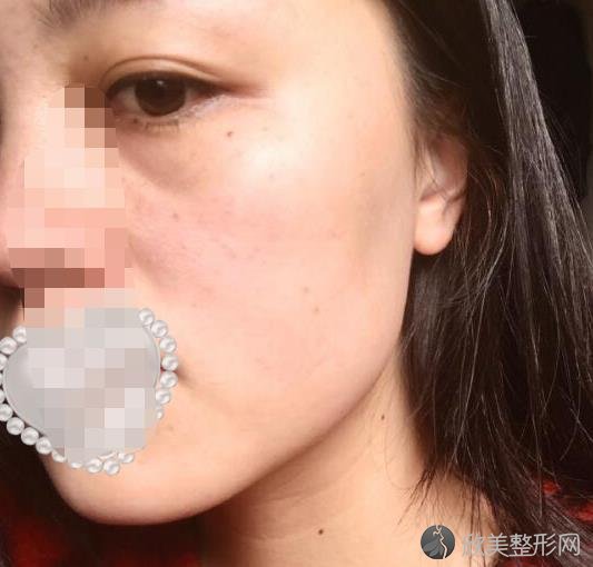上海华美医疗美容医院常春医生做激光祛斑之后