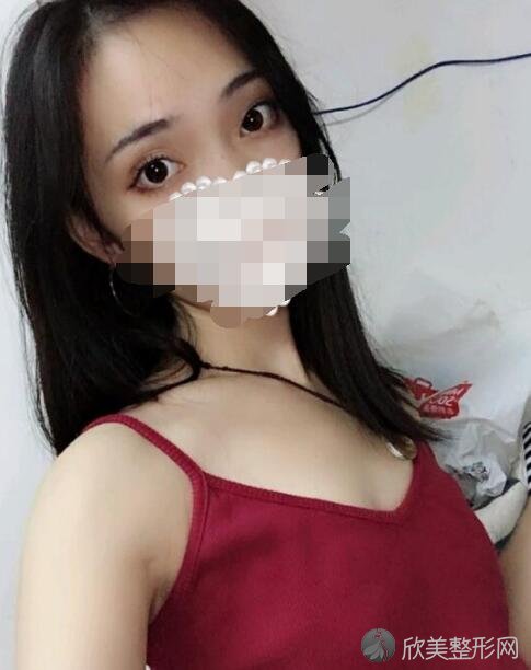 <a href='https://www.joshreso.com/project/731.html' target='_blank'><u>假体隆胸</u></a>术前