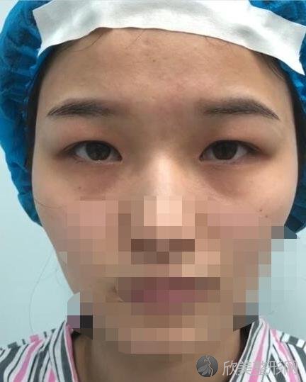 北京美莱医疗美容医院刘晓荣医生全切双眼皮手术之前